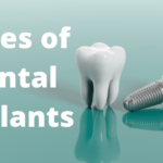 Types of Dental Implants Complete Guide