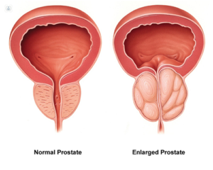 Prostate Cancer Treatment Hospital
